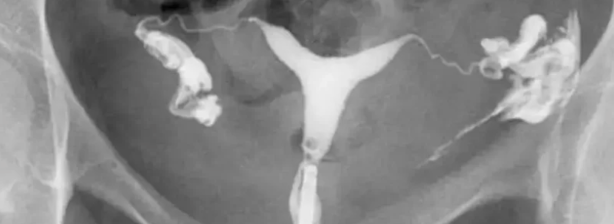 هیستروسالپنگوگرافی چیست؟ بررسی کامل کاربردها، مزایا و نتایج