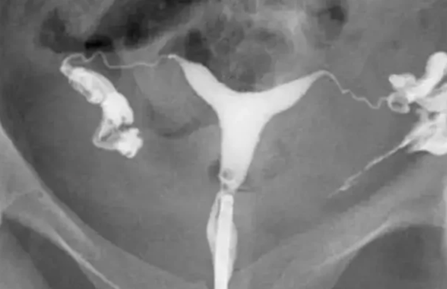 هیستروسالپنگوگرافی چیست؟ بررسی کامل کاربردها، مزایا و نتایج